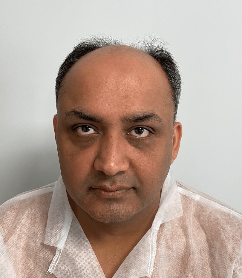 DHI hair transplant illustrative image